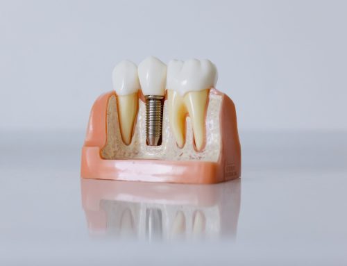 Zirconia vs. Titanium Dental Implants